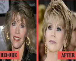 Jane Fonda before surgery